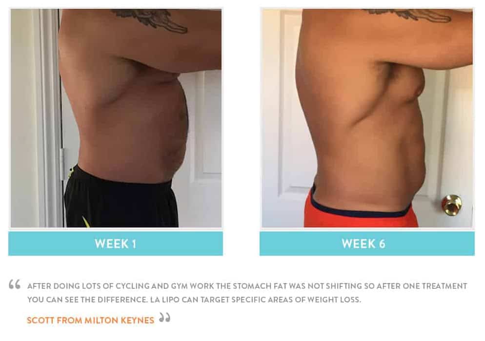 Before & After Stomach Fat Lichfield