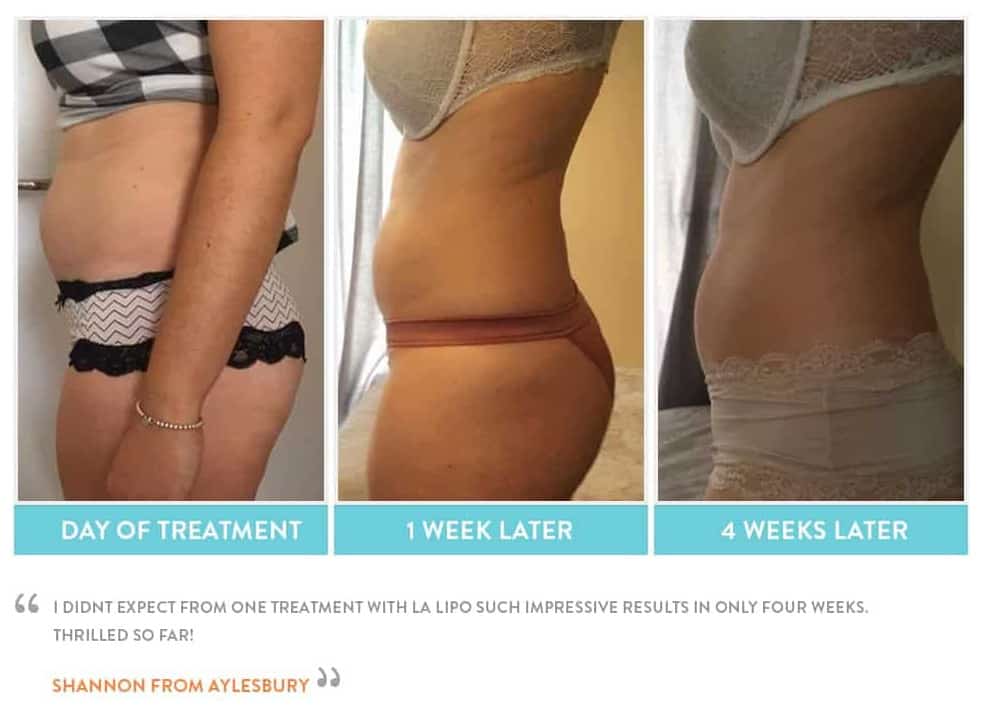 before, Cryolipolysis Lichfield
