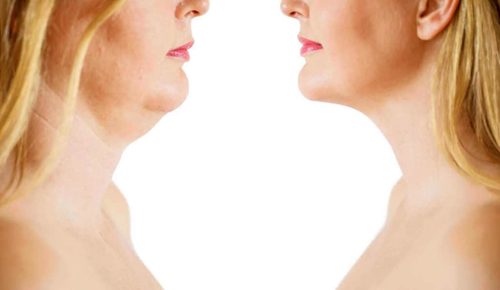 Double Chin treatment Lichfield before and after results