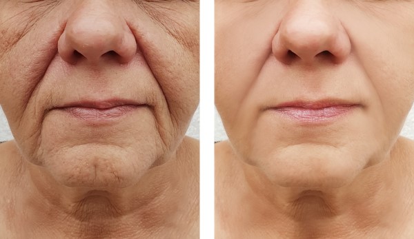 Learn more about Morpheus8 Treatment Lichfield today!