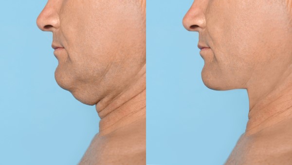 Which Non-Surgical Treatments Work Best for Jowls and Loose Skin Lichfield?