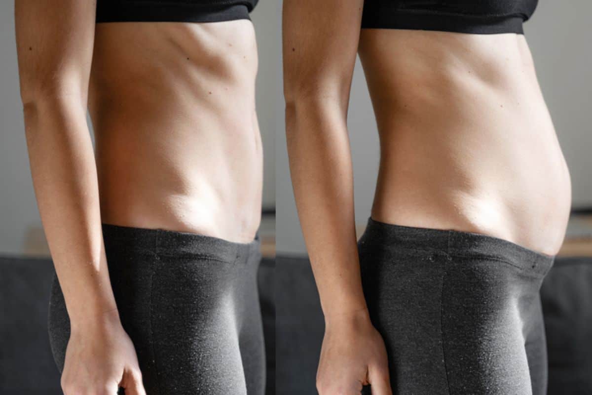 How long does diastasis recti take to improve Lichfield?
