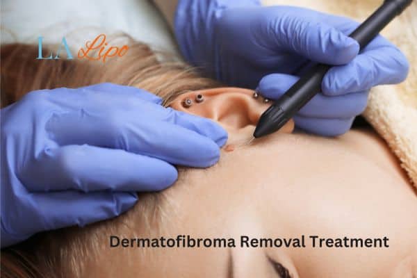 Dermatofibroma Removal Treatment Lichfield