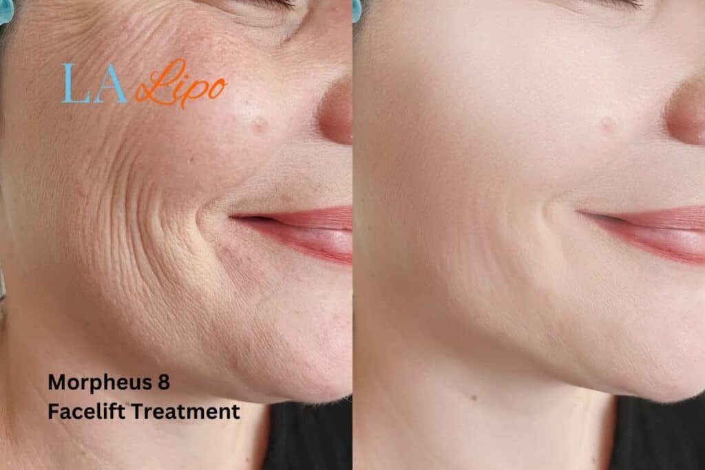 Morpheus8 Treatment Lichfield for flawless skin! Call us today!