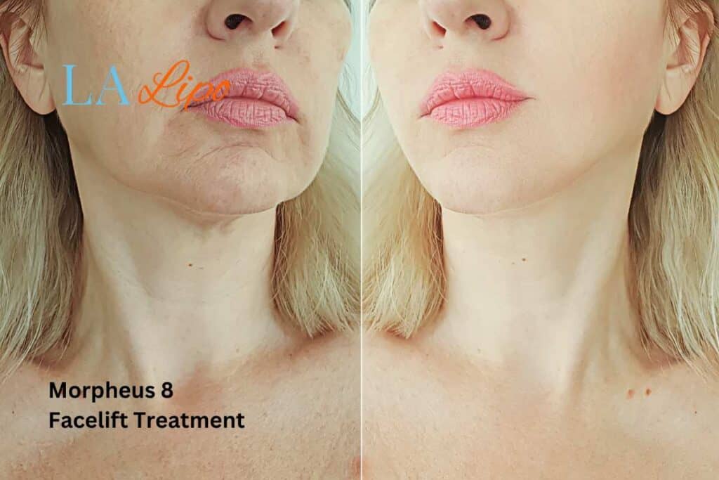 Turn back time with Morpheus8 Treatment Lichfield