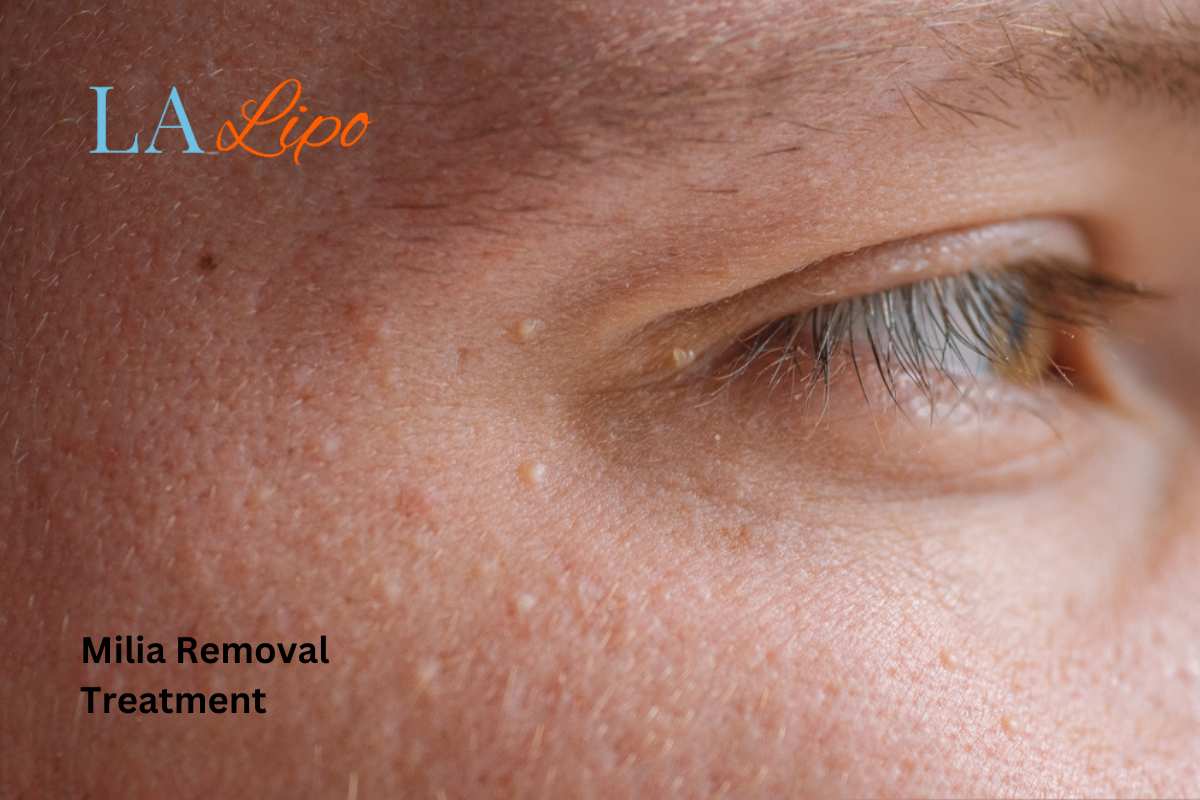 Cryopen Milia Removal: Is It the Easiest and Safest Option Lichfield?