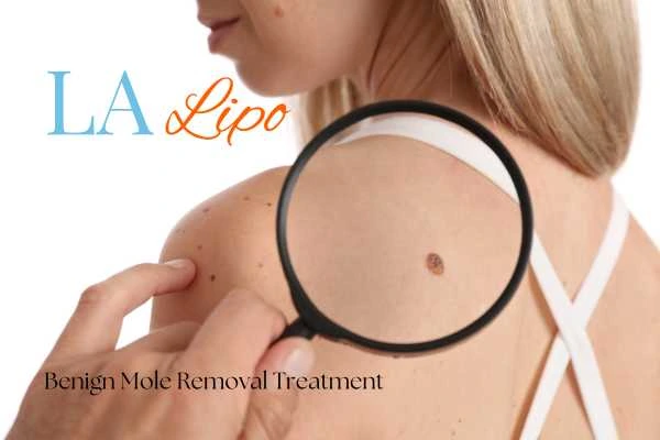 Woman having her inspection of blemish before mole removal Lichfield