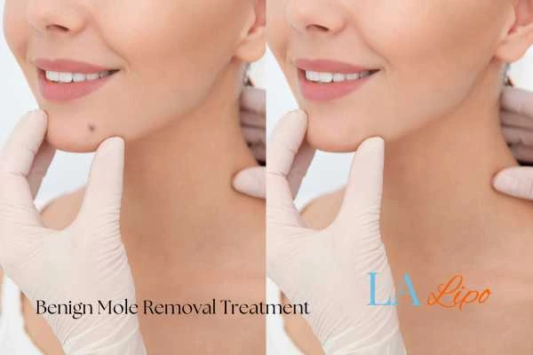 woman's before and after mole removal Lichfield results