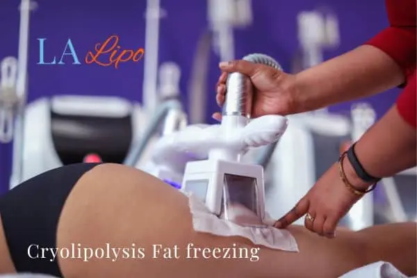 women getting fat freezing Lichfield