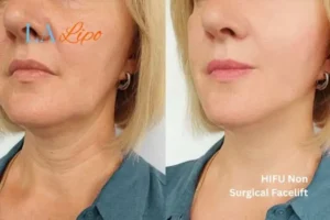 hi-fu for wrinkles Lichfield before and after results
