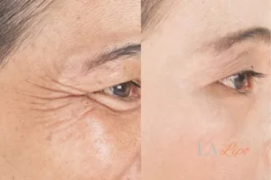 Before and after results of woman - HI-fu wrinkles reduction treatment Lichfield