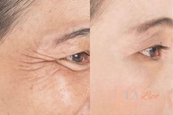 Before and after results of woman - HI-fu wrinkles reduction treatment Lichfield