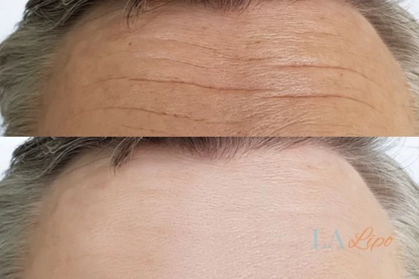 results of HIFU Lichfield on mans forehead to help reduce lines and wrinkles