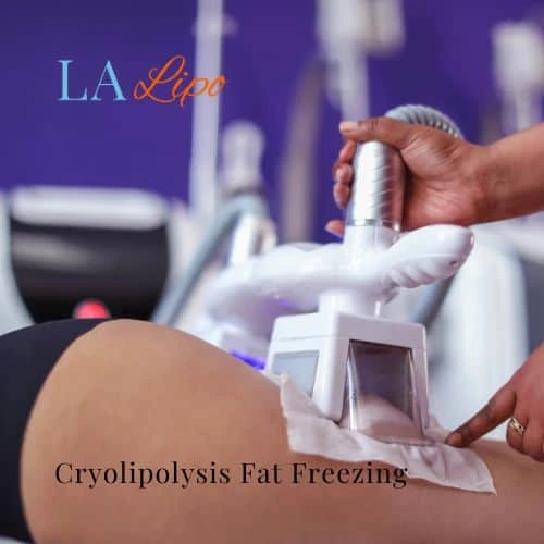 fat freezing - Cryolipolysis Lichfield