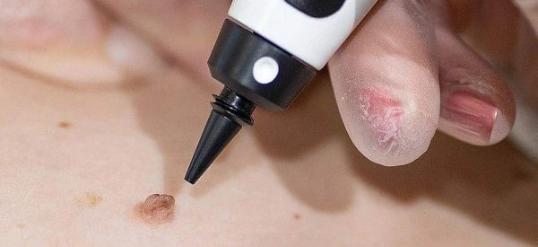 skin tag removal using cryopen Lichfield