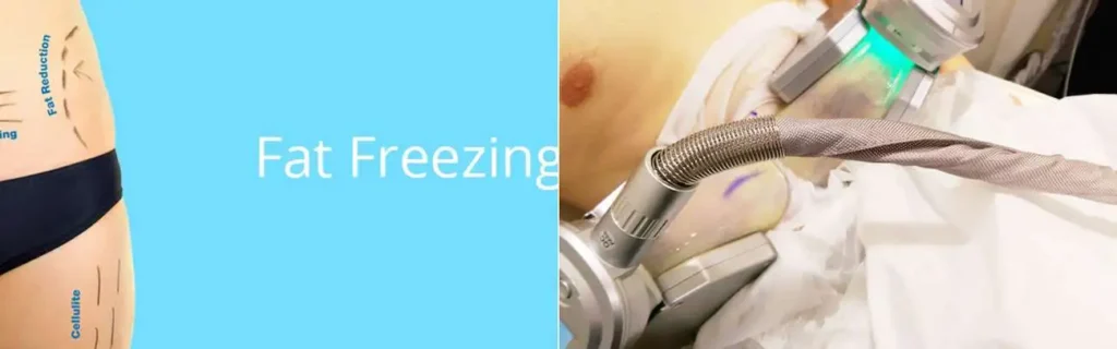 multi areas of a persons body having coolsculpting Lichfield treatment