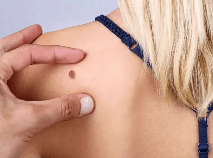 woman having mole removal Lichfield consultation before treatment.