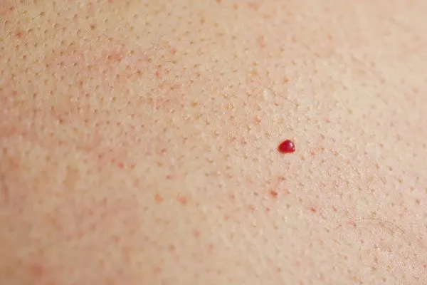 close up of a cherry angioma Lichfield