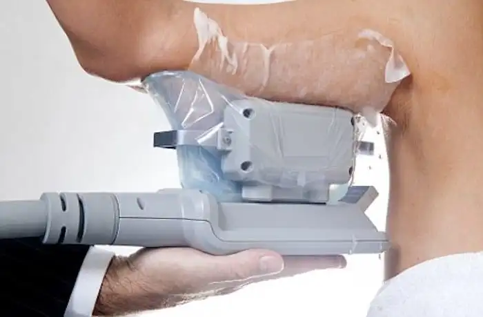 Picture of fat freezing Lichfield on the upper arms.