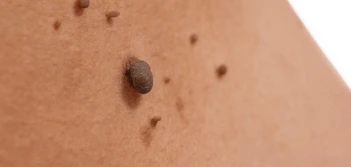 image of a skin tag Lichfield
