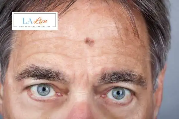Solar Lentigo Removal Lichfield image of man with mark on his forehead