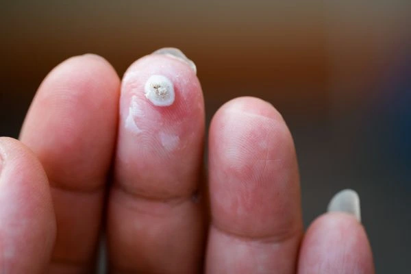 wart on person finger - cryotherapy to treat from LA LIPO Lichfield