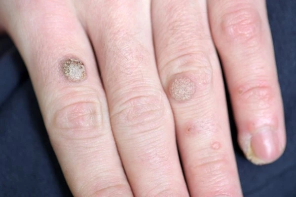 photo of warts on person hand - see wart removal Lichfield from LA LIPO