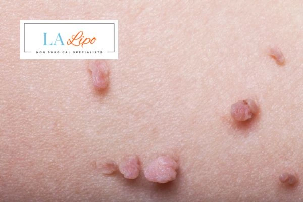 Does cryopen skin tag removal Lichfield hurt? Find out now call our team today!
