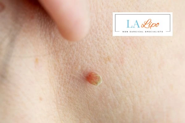 Book skin tag removal Lichfield today speak to our team now!