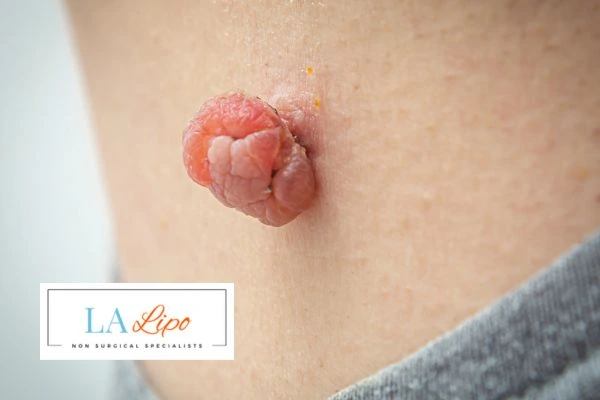 Interested in skin tag removal Lichfield? Concerned about the pain? Find out more today!