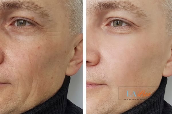 See the amazing results of Morpheus8 Treatment Lichfield!