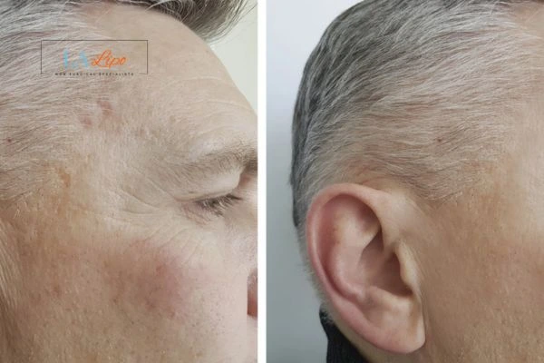 Mens Before & After Morpheus 8 Results Lichfield