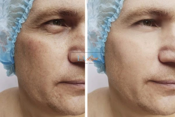 Before and after Morpheus 8 Results Lichfield
