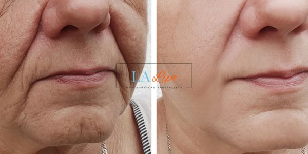 Older lady deeper wrinkle reduction - LA LIPO Morpheus 8 Results Lichfield