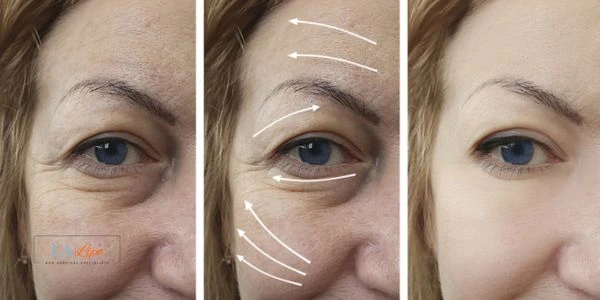 Amazing eye lift Morpheus 8 results Lichfield