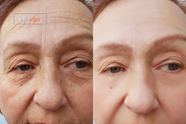 The powerful benefits of Morpheus8 Treatment Lichfield - Call Our team today!