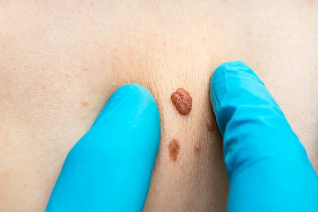 LA LIPO Cryopen Lesion Removal Prices Lichfield