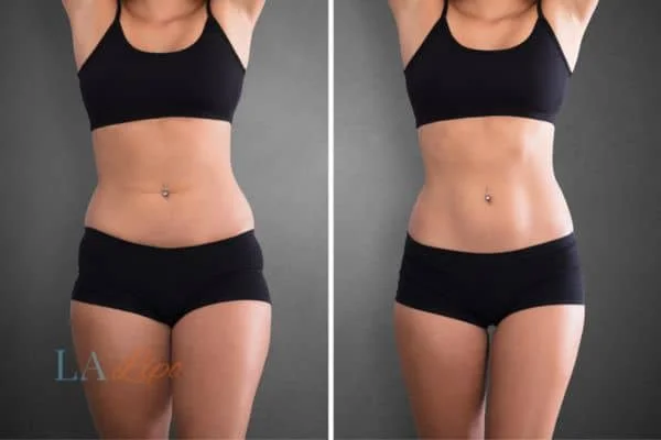 before and after results of non-surgical treatment to help a woman's body image and mental health Lichfield