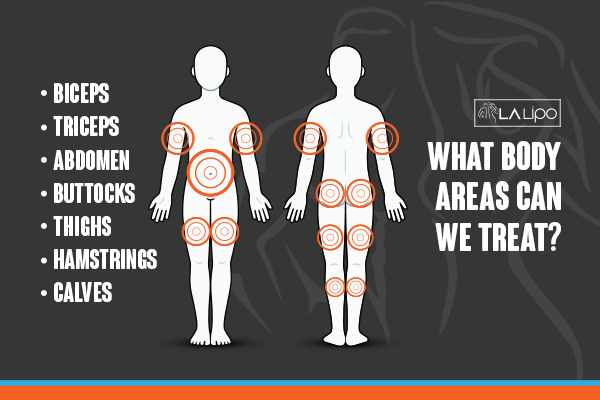 Diagram to show areas you can have LA-EMS Body Sculpting Treatment Lichfield
