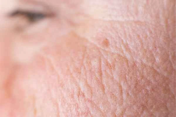 close up picture of a woman's face showing an age spot Lichfield