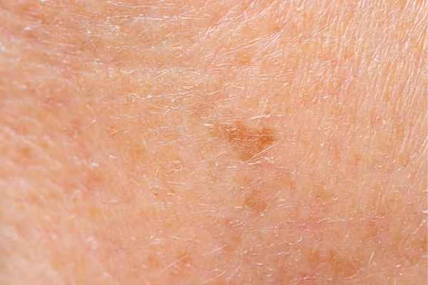 close up picture of age spots Lichfield