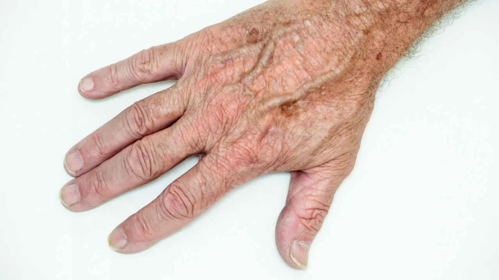 Male hand showing age spot Lichfield