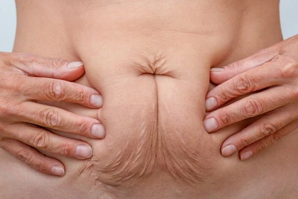 Image of a woman's stomach with loose skin - example of skin tightening Lichfield options