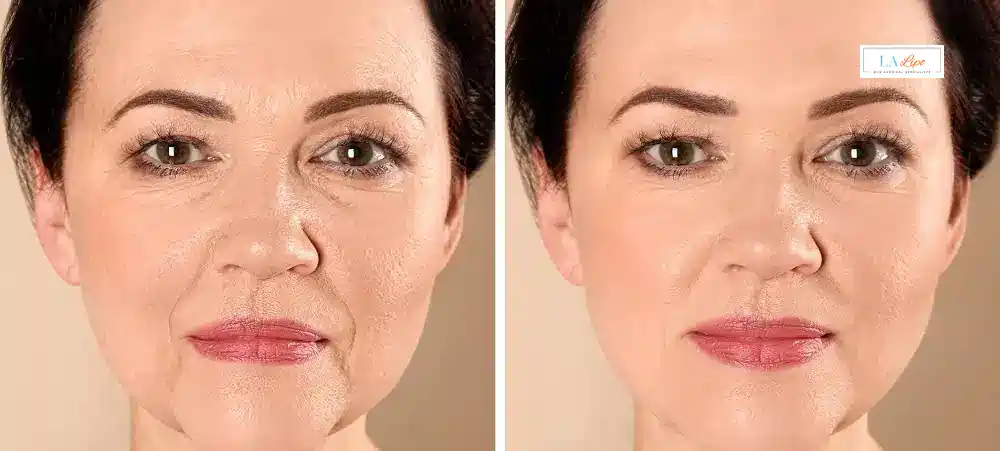 How Long Does It Take to See Results and How Long Do They Last Lichfield?