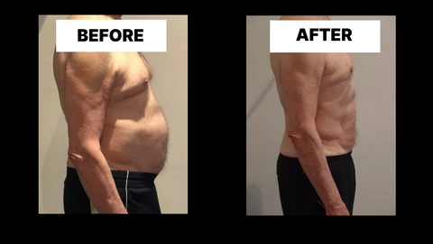 What Symptoms Can Diastasis Recti Cause in Men? Weak Core, Back Pain and Poor Posture Lichfield